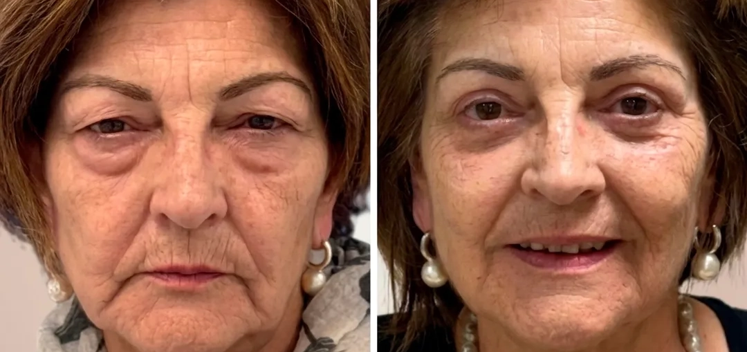 O nosso cirurgião, Santiago Elvira, explica na Antena 3 os retoques estéticos que marcam tendência