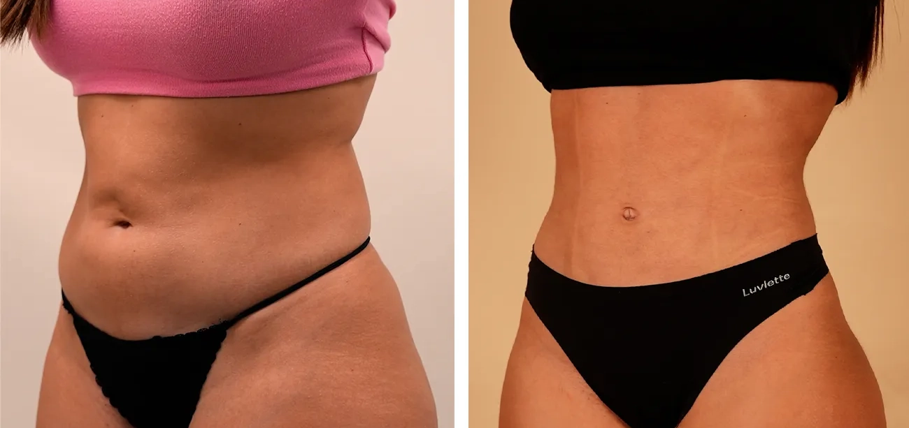 O nosso cirurgião, Santiago Elvira, explica na Antena 3 os retoques estéticos que marcam tendência