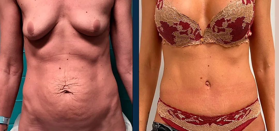 O nosso cirurgião, Santiago Elvira, explica na Antena 3 os retoques estéticos que marcam tendência