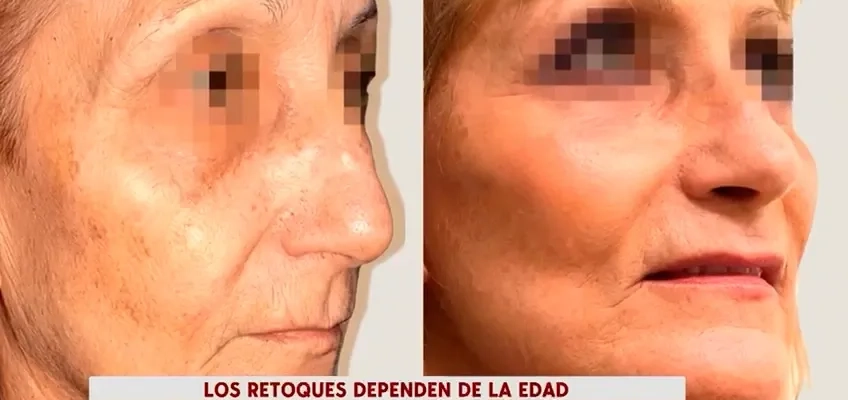 Aesthetic surgery in adults: our surgeon, Tiago Gomes, explains on Cuatro