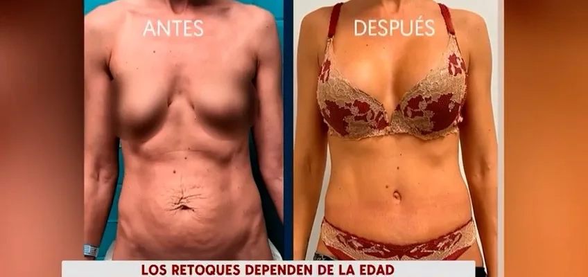 Aesthetic surgery in adults: our surgeon, Tiago Gomes, explains on Cuatro