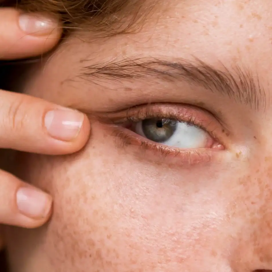 How is the under-Eye filler procedure done?