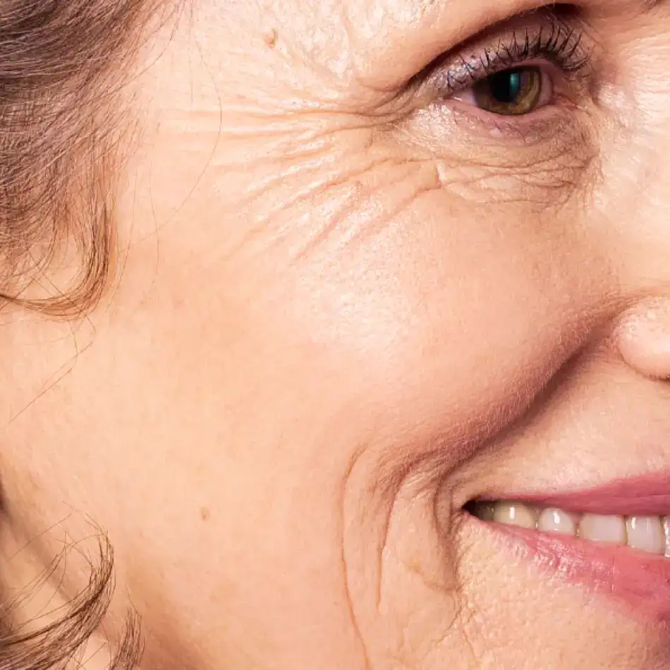 ¿Cómo se realiza el procedimiento de eliminación de arrugas de expresión?