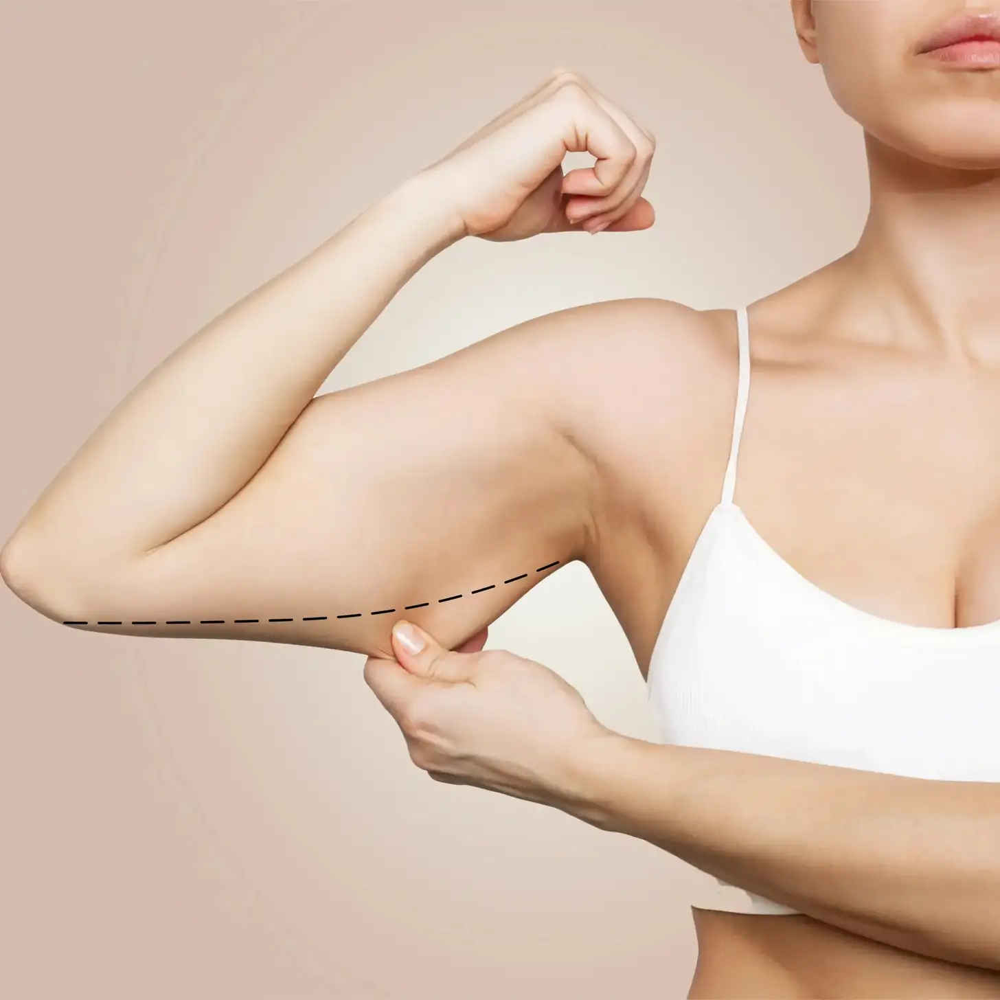 Com es realitza el procediment de lifting de braços o braquioplàstia?