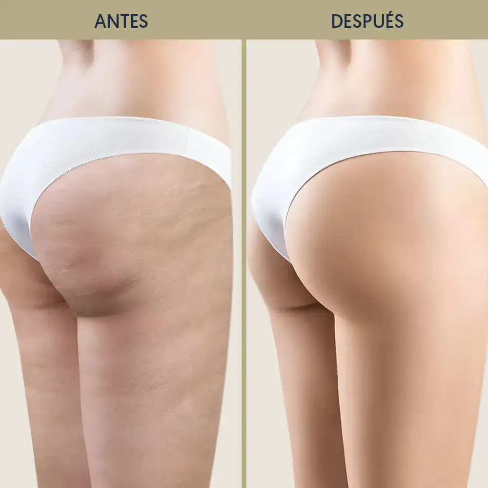 Fotos de antes y después de la presoterapia