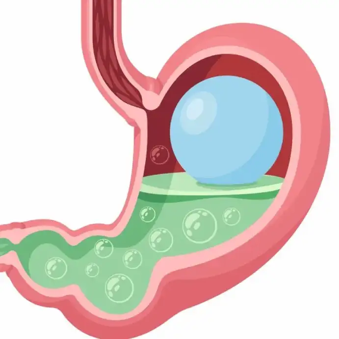 Leer información relacionada a ¿Cómo funciona el balón gástrico?