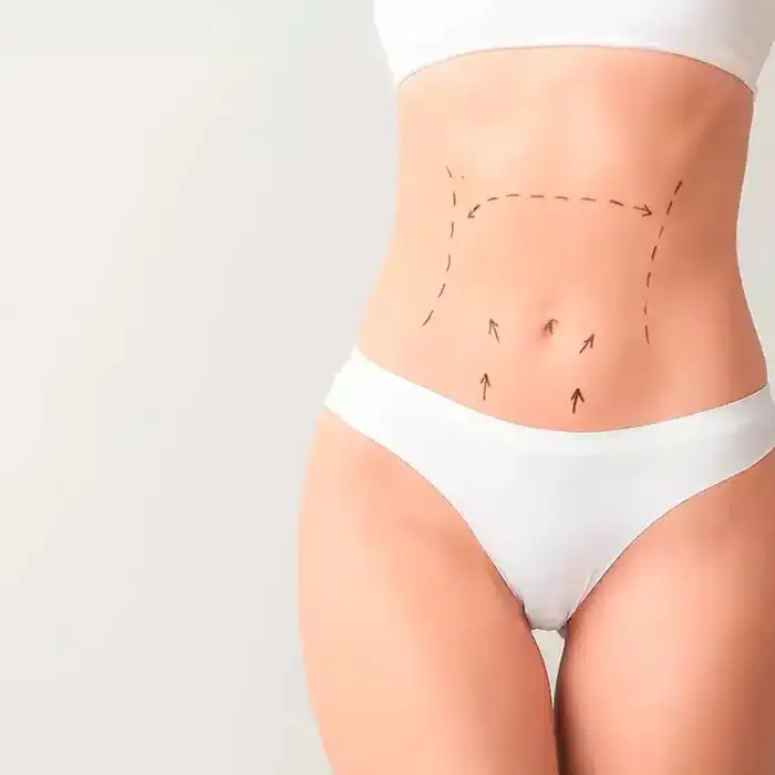 Leer información relacionada a Evolución de la cicatriz de una abdominoplastia
