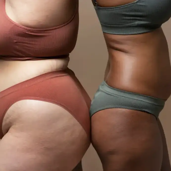 Leer información relacionada a Todo sobre el lipedema: qué es y cómo se trata