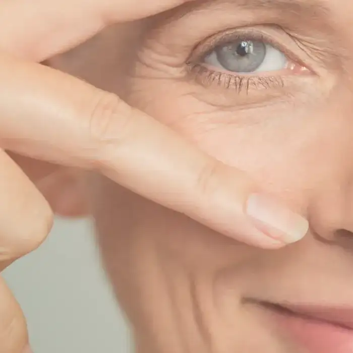 Leer información relacionada a Todo sobre la Blefaroplastia Inferior: cicatriz, precio y recuperación