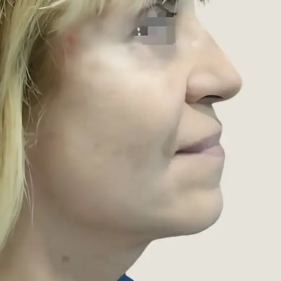 Después de Chin removal