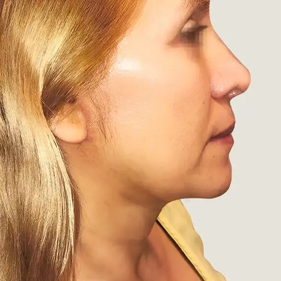 Después de Chin removal