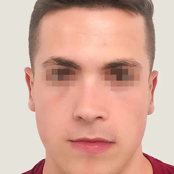 Después de Otoplastia