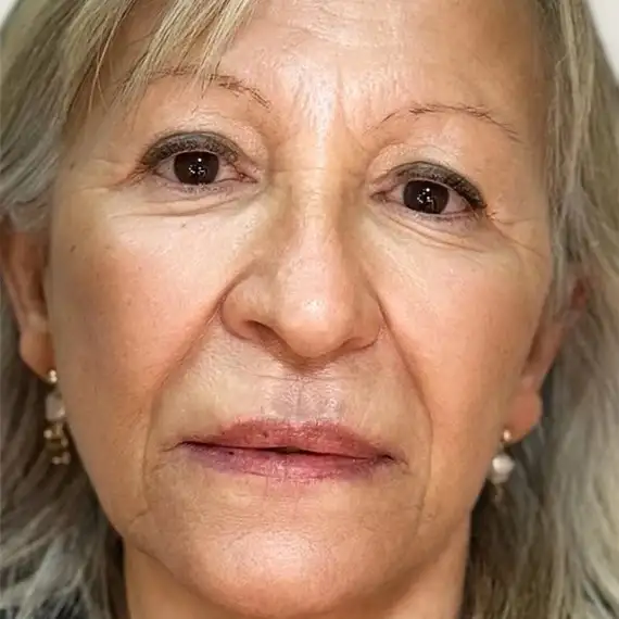 Después de Facial rejuvenation