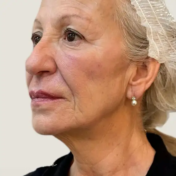 Después de Facial rejuvenation