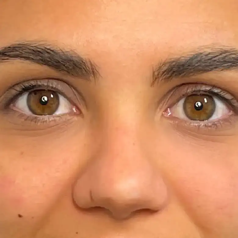 Después de Tear trough filler