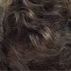 Después de Hair mesotherapy