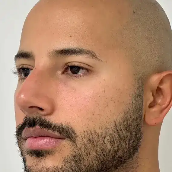 Después de Tear trough filler