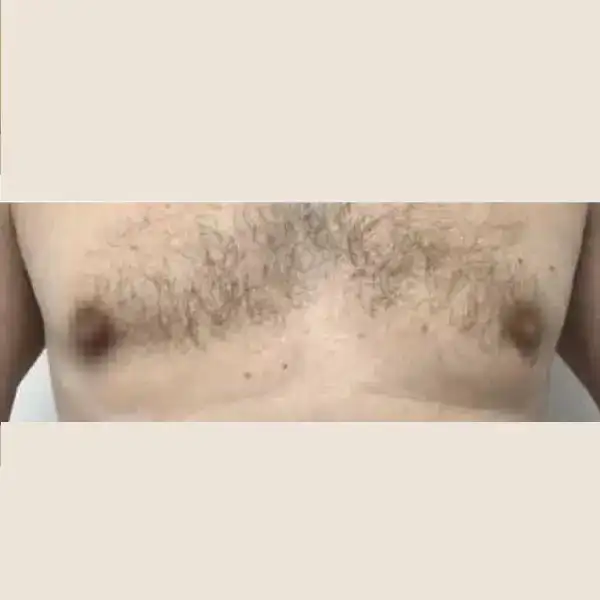 Después de Gynecomastia