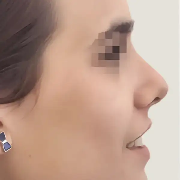 Después de Rinoplastia secundaria