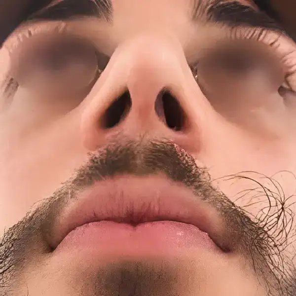 Después de Rinoplastia secundaria