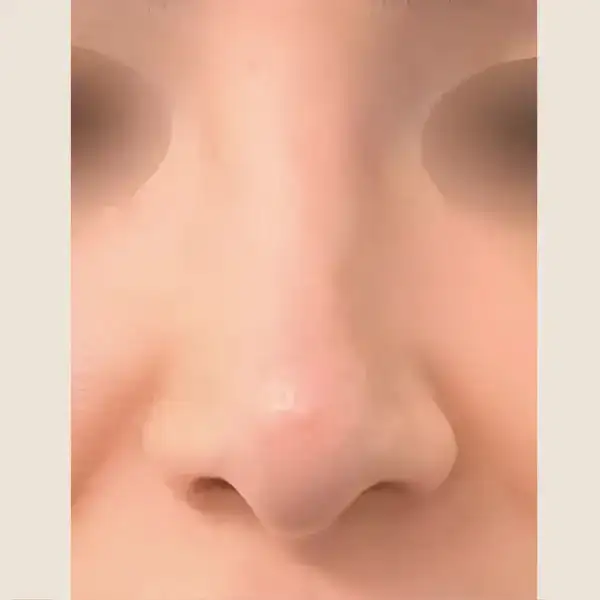 Después de Rinoplastia secundaria