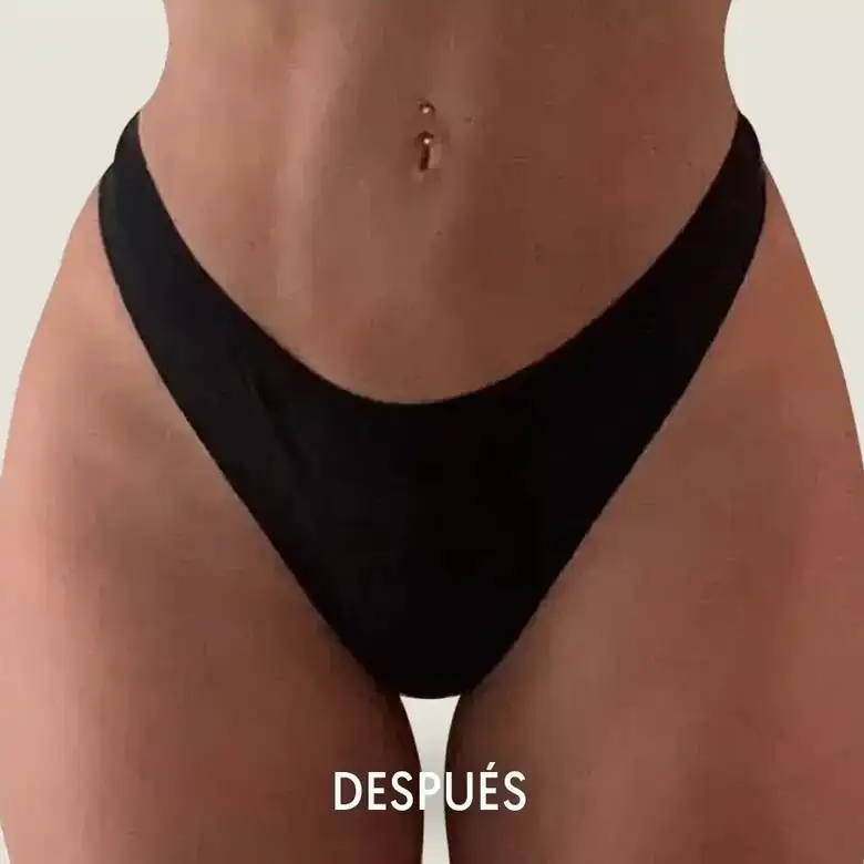 Después de Buttock augmentation