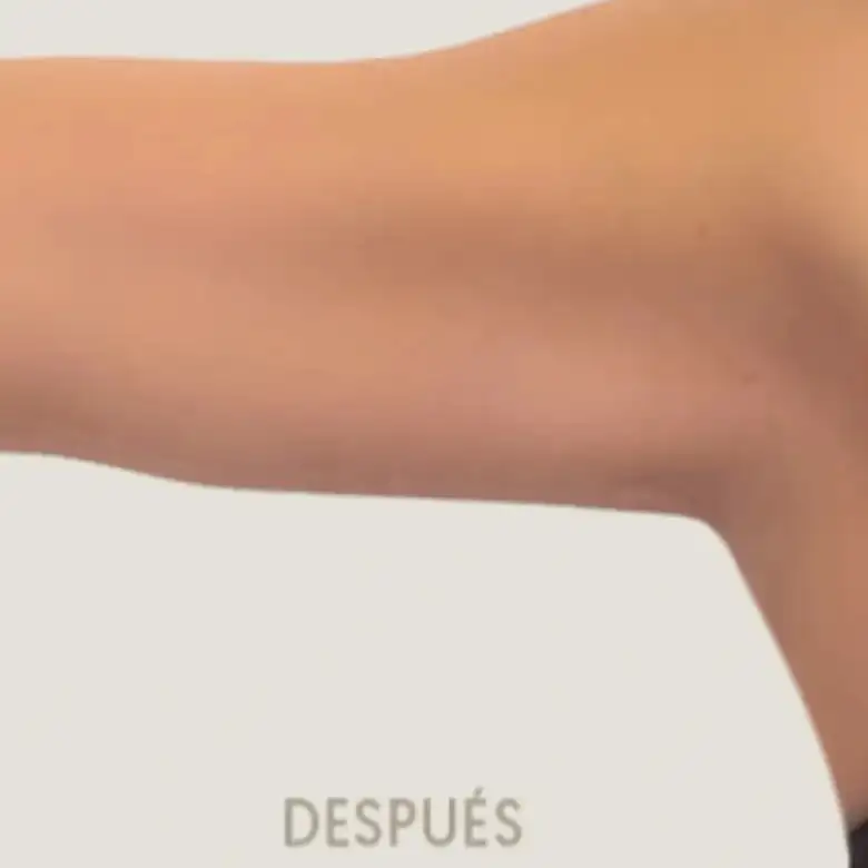 Después de Brachioplasty