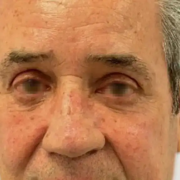 Después de Antes y después de una Blefaroplastia