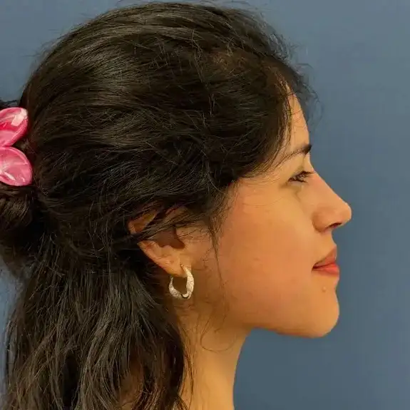 Después de Rinoplastia Ultrasonic Rhinoplasty