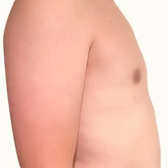 Después de Gynecomastia