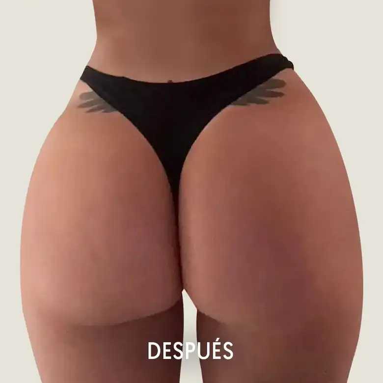 Después de Buttock augmentation