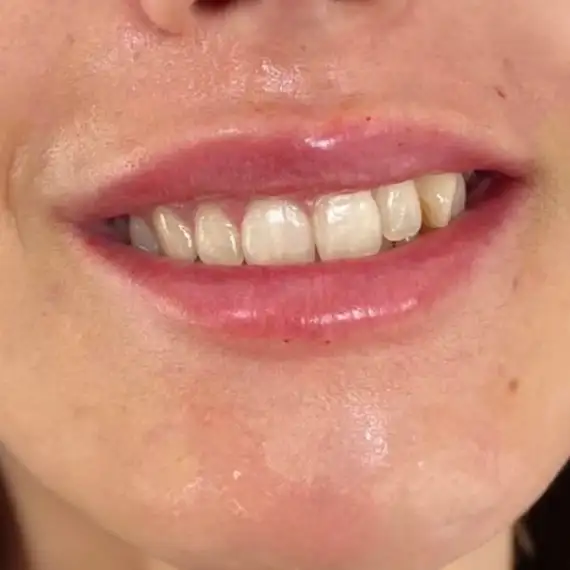 Después de Sonrisa gingival