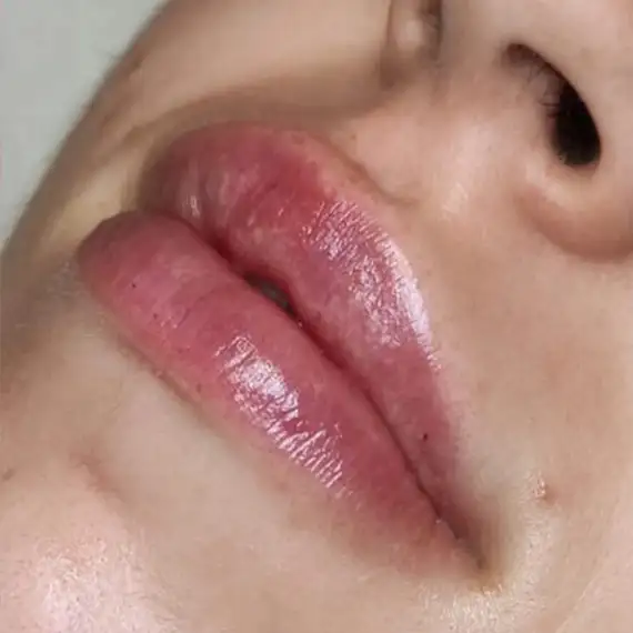 Después de Relleno de labios