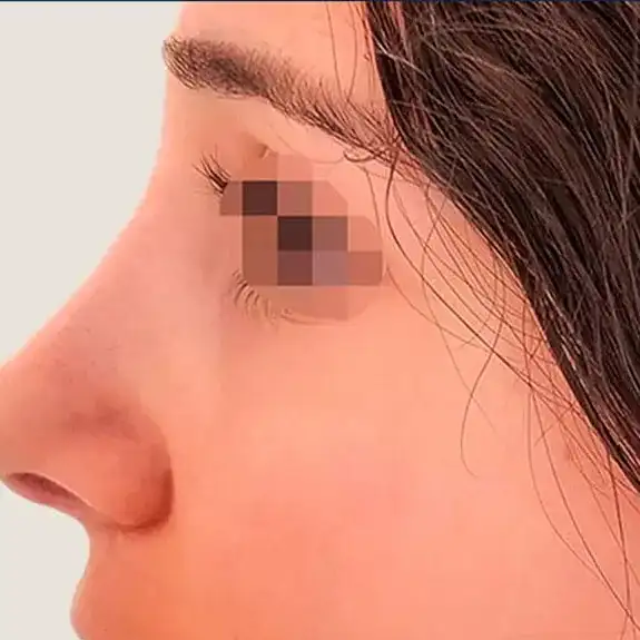 Después de Ultrasonic Rhinoplasty