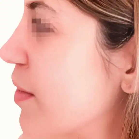Después de Ultrasonic Rhinoplasty