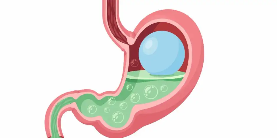 How does the gastric balloon work?