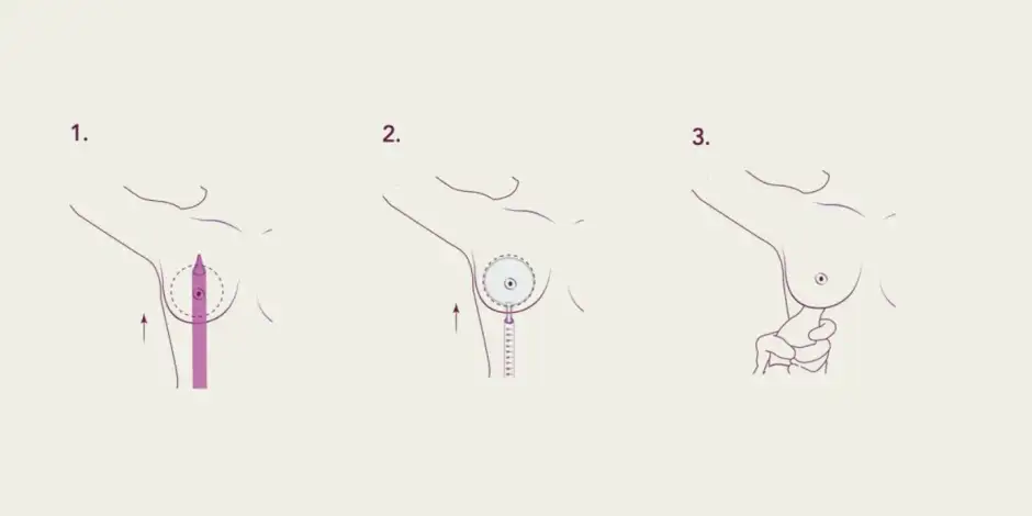 Preservé: The Minimalist Technique that cares for your breast sensitivity