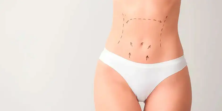 Evolución de la cicatriz de una abdominoplastia