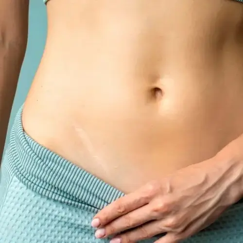 Eliminar cicatrius: Llueix una pell sense imperfeccions.