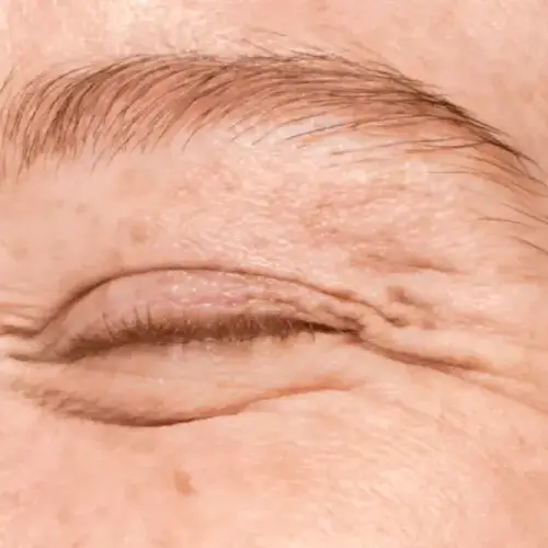 Eliminar arrugas de expresión: luce 10 años más joven