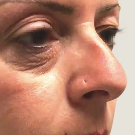 Antes de Antes y después de una Blefaroplastia