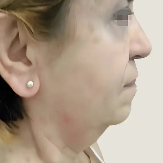 Antes de Chin removal