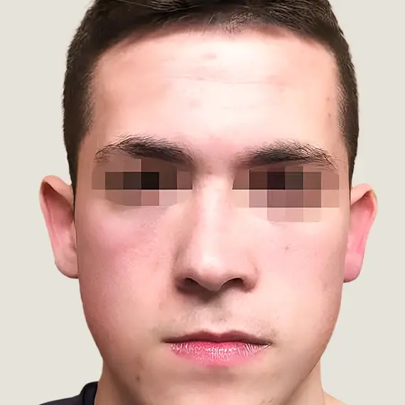 Antes de Otoplastia
