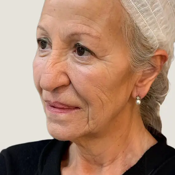 Antes de Rejuvenecimiento facial