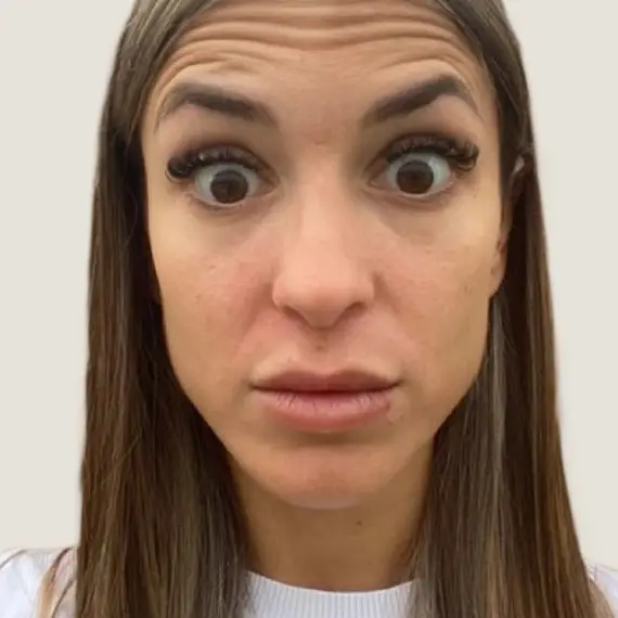 Antes de Expression line treatment