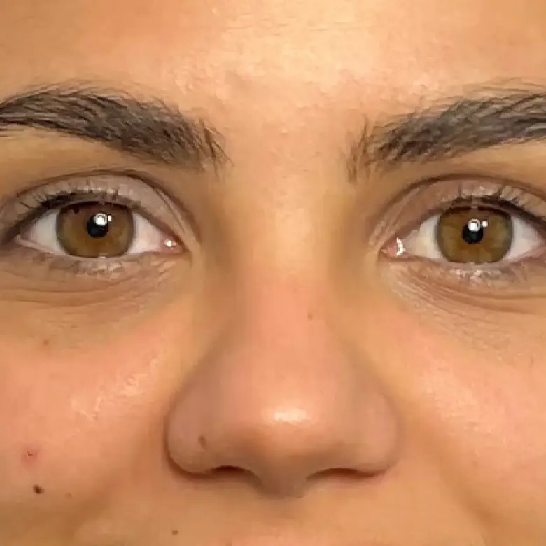 Antes de Tear trough filler