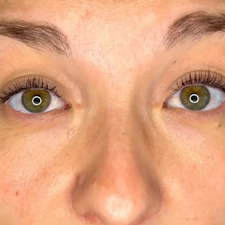 Antes de Tear trough filler