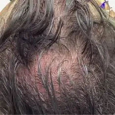 Antes de Hair mesotherapy