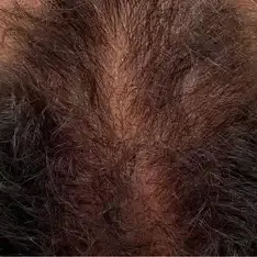 Antes de Hair mesotherapy