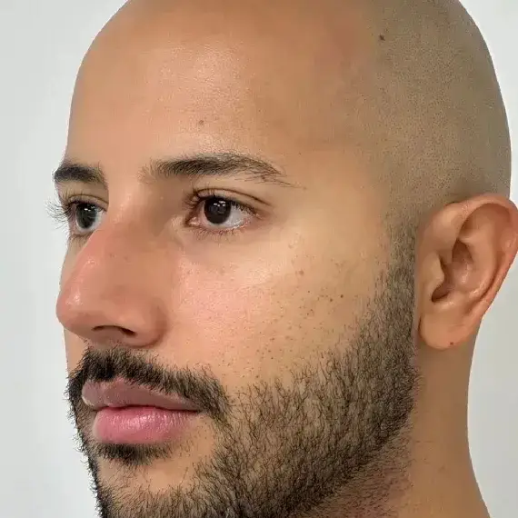 Antes de Tear trough filler